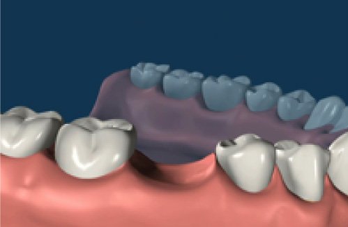 Dental Implant Procedure