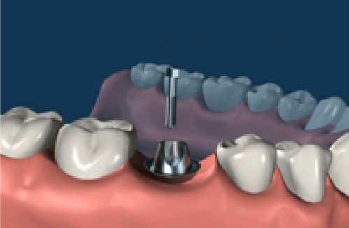 Dental Implant Procedure